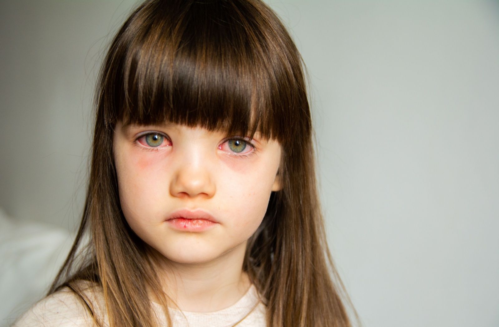 Close-up of a child's face with puffy, red eyes due to conjunctivitis.