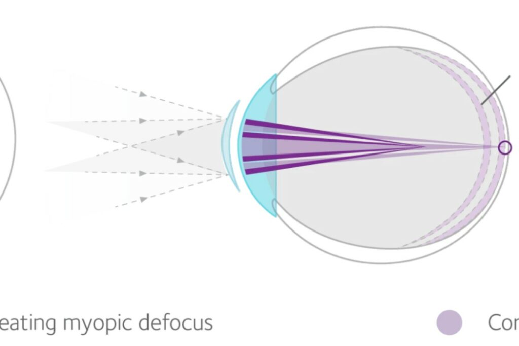 An anatomical diagram of a human eye showing light rays passing through a contact lens. It illustrates myopic defocus, where some light rays focus directly on the retina for clear vision while others focus in front of the retina to help slow myopia progression.